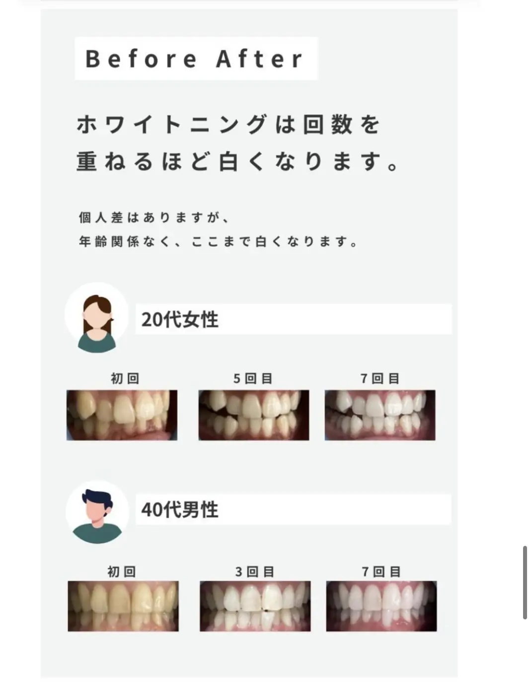 セルフホワイトニング Before After
